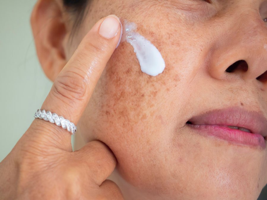 Une femme asiatique applique une crème pour le traitement du visage, un problème de pigmentation du mélasma sur son visage.