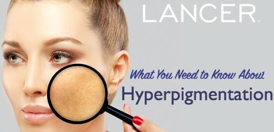 Ce que vous devez savoir sur l'hyperpigmentation