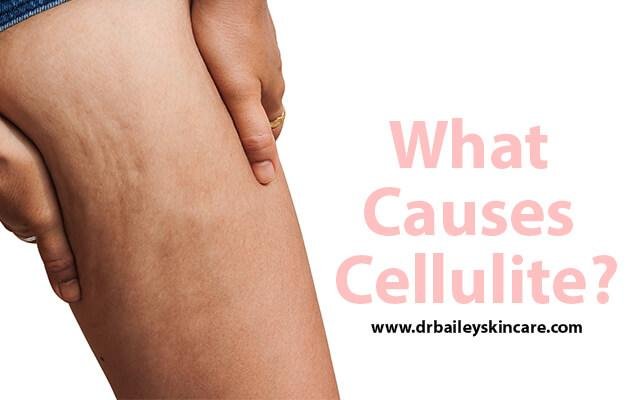 Quelles sont les causes de la cellulite? Êtes-vous prédisposé à la cellulite?