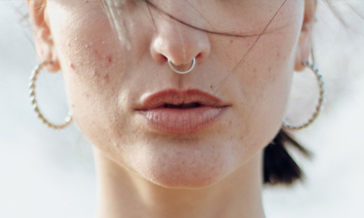 Comment j'ai finalement éliminé mon acné d'adulte, avec l'aide d'un dermatologue