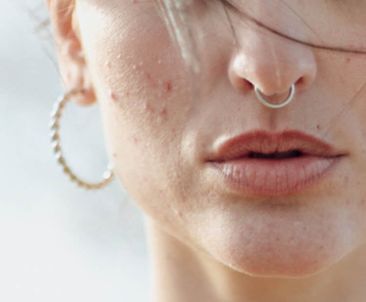 Visage de femme avec une poussée d'acné