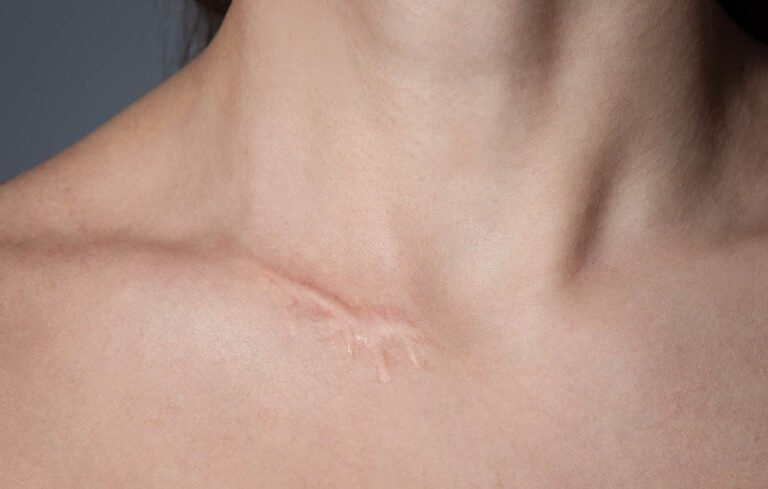 Comment estomper et prévenir les cicatrices