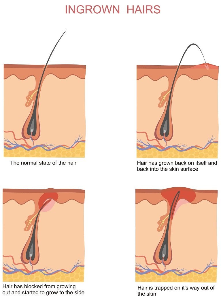 How to Prevent Ingrown Hairs