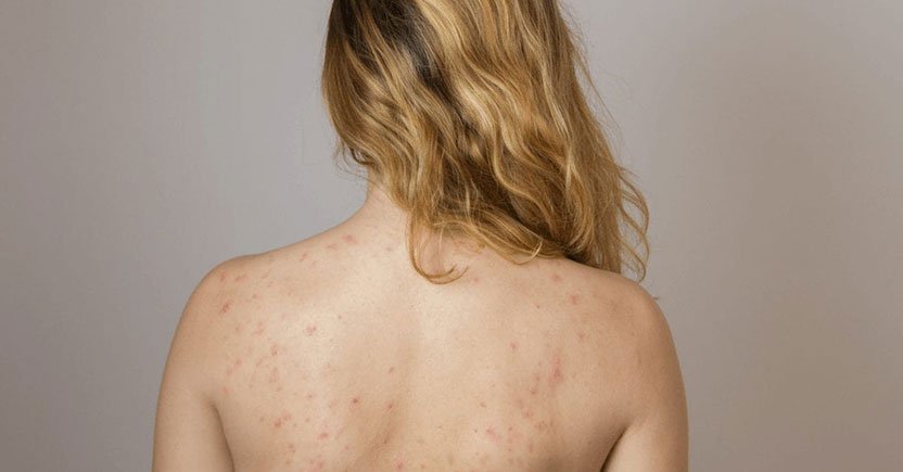 Cicatrices d'acné et comment les traiter-min