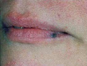 Que faire en cas d'angiome sur la lèvre ?