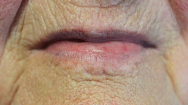 Angiome lèvre : tâche bleue sur les lèvres