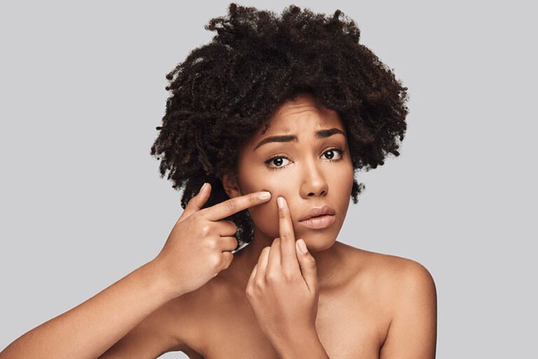 Qu’est-ce qui cause l’acné chez l’adulte ?  |  LancerSkincare.com